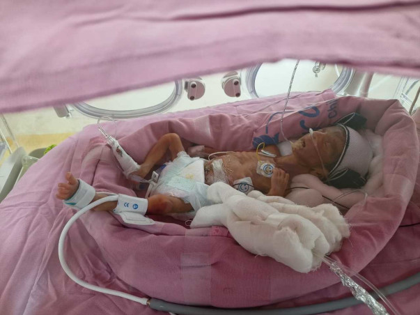 My Baby Needs Your Help To Survive Premature Birth Complications