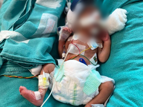 Extremely Premature Baby Weighing 935 gms Is Fighting For His Life