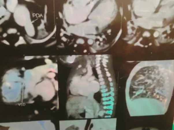 *Help My Baby Boy To Recover Heart Disease*