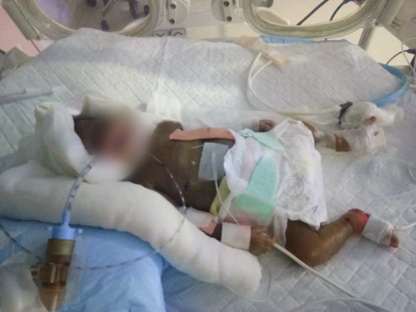 28 Days Old Baby of Ranjana Needs Your Help .