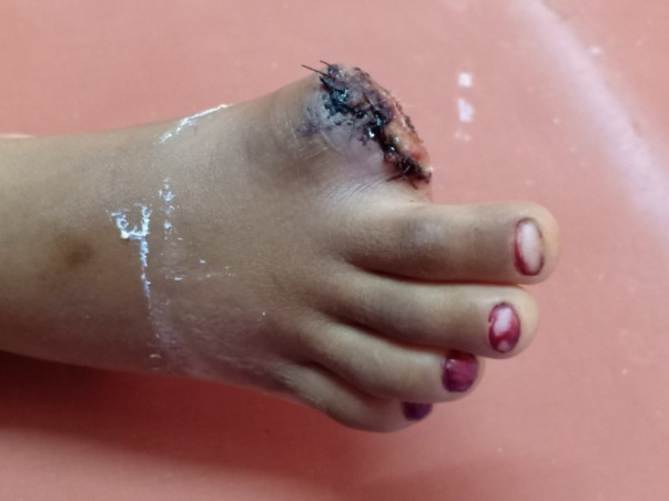 Support 5years Old  Siri For Artificial Finger