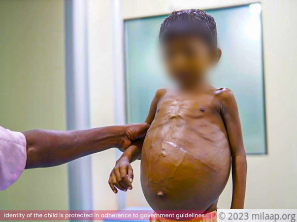 This Father Is Struggling To Save His Child From Severe Liver Damage