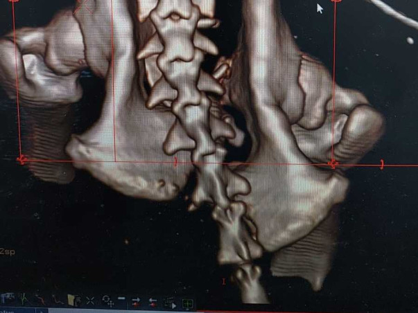 Support Charlie Recover From Spine Fracture