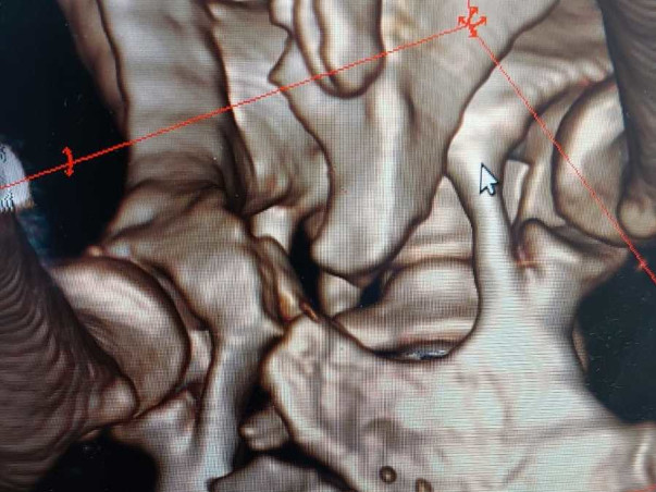Support Charlie Recover From Spine Fracture