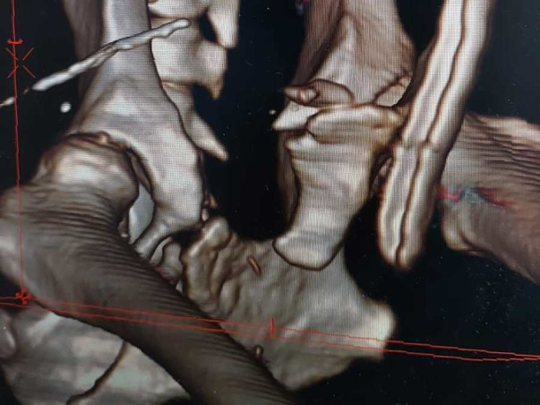 Support Charlie Recover From Spine Fracture