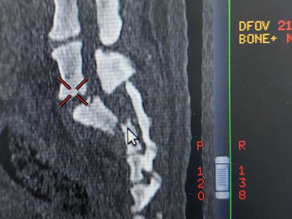 Support Charlie Recover From Spine Fracture
