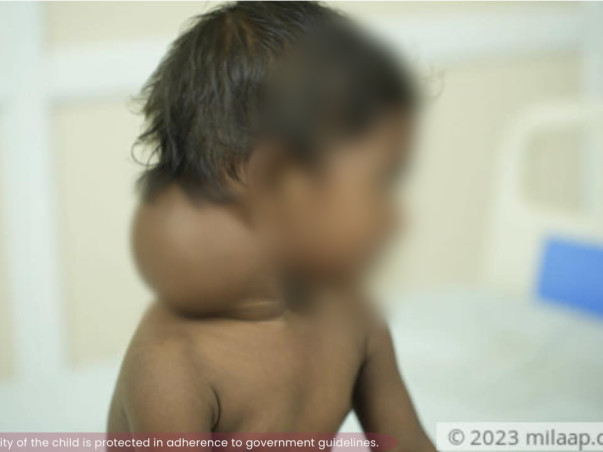 Burdened By Massive Neck Tumour, 1-Year-Old Needs Life-Saving Surgery