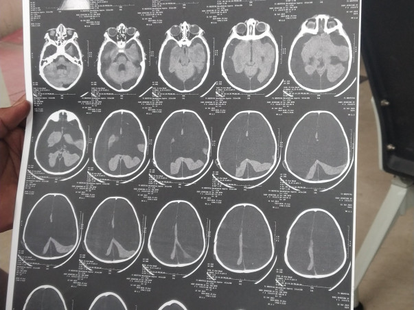 Support Chutki to survive from Brain fluid issue